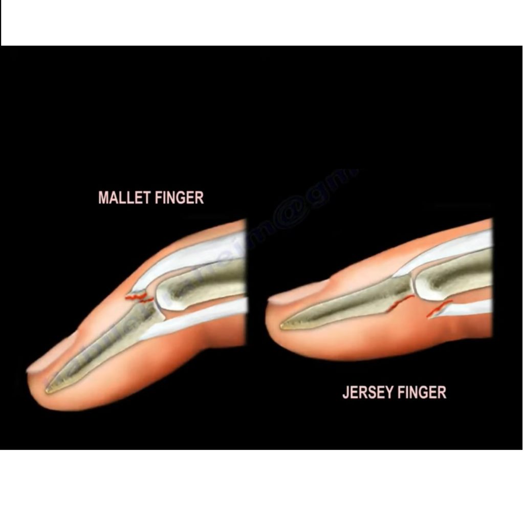 Mallet Finger Mechanism of Injury and Treatment