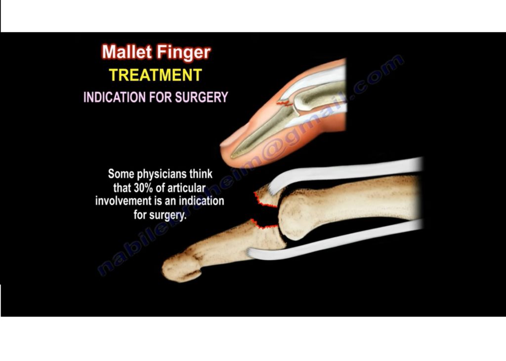 What is the most appropriate treatment for a mallet finger?