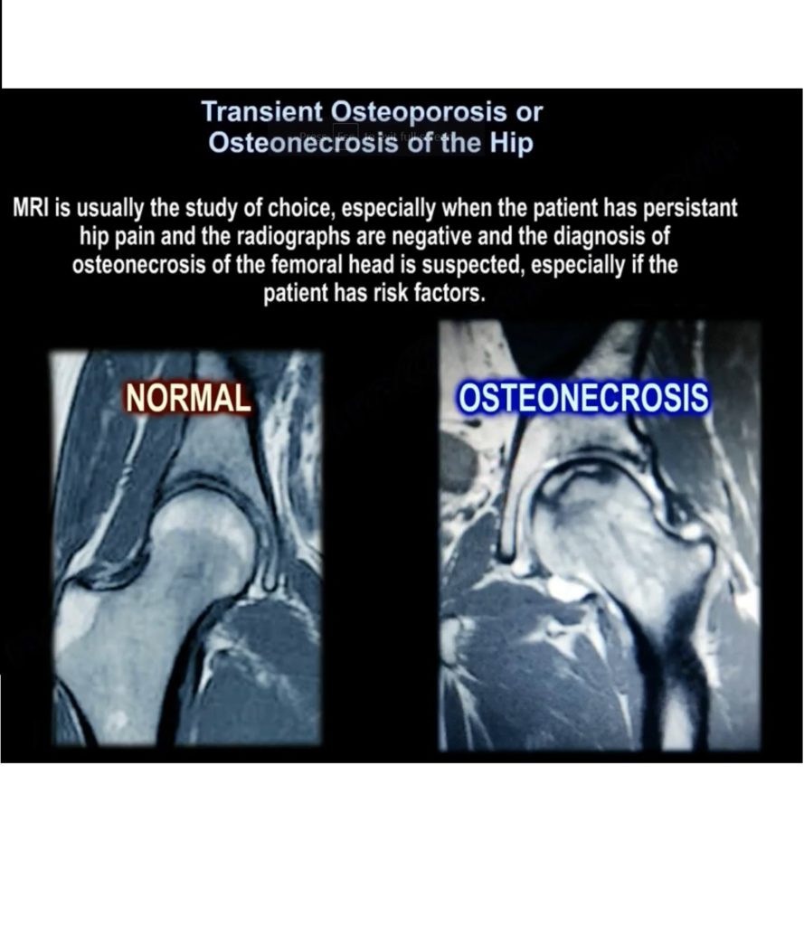 Osteonecrosis Of The Hip —