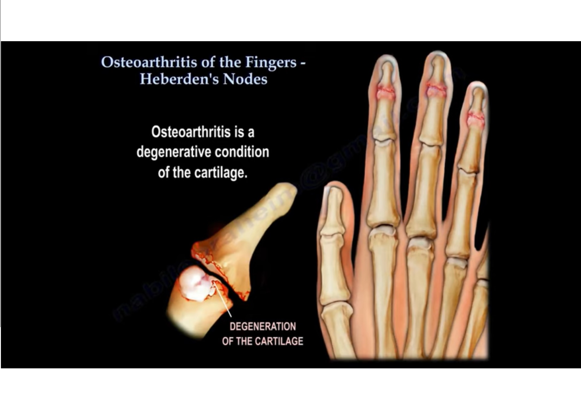 Osteoarthritis Of The Fingers —