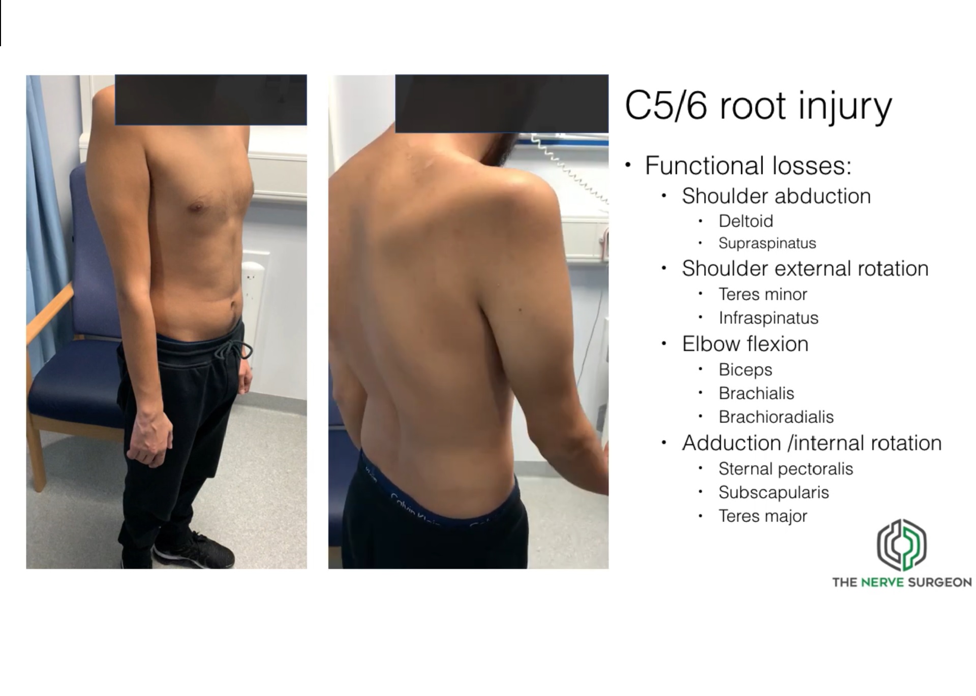 Adult Traumatic Brachial Plexus Injuries OrthopaedicPrinciples