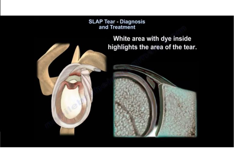 SLAP Tear Diagnosis and Treatment —