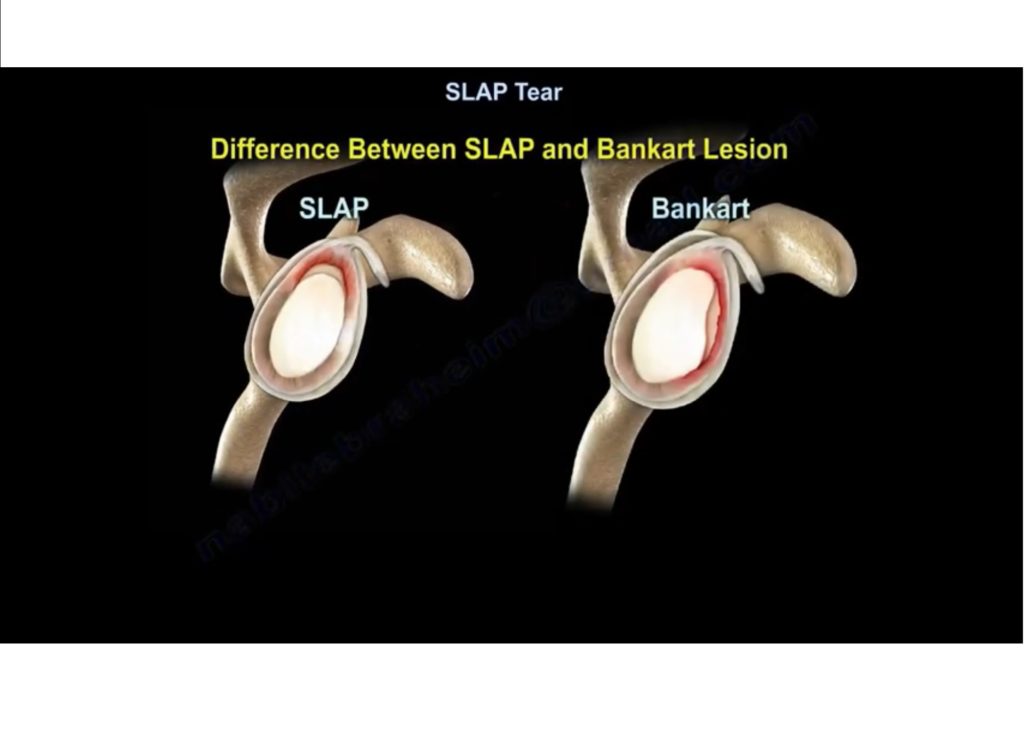 slap-tear-orthopaedicprinciples