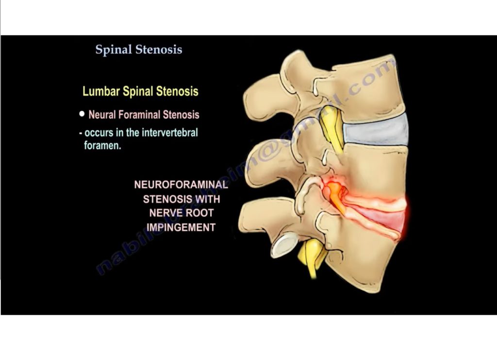 spinal-canal-stenosis-orthopaedicprinciples