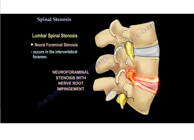 Spinal Canal Stenosis — OrthopaedicPrinciples.com