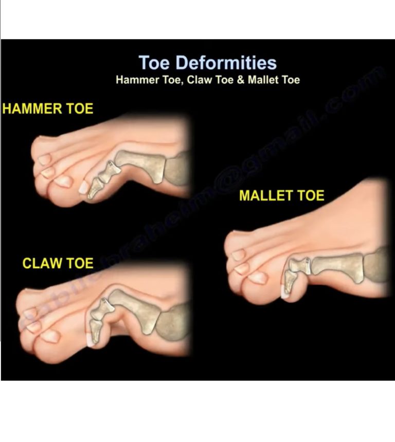 Toe Deformities Hammer Toe, Claw Toe, Mallet Toe