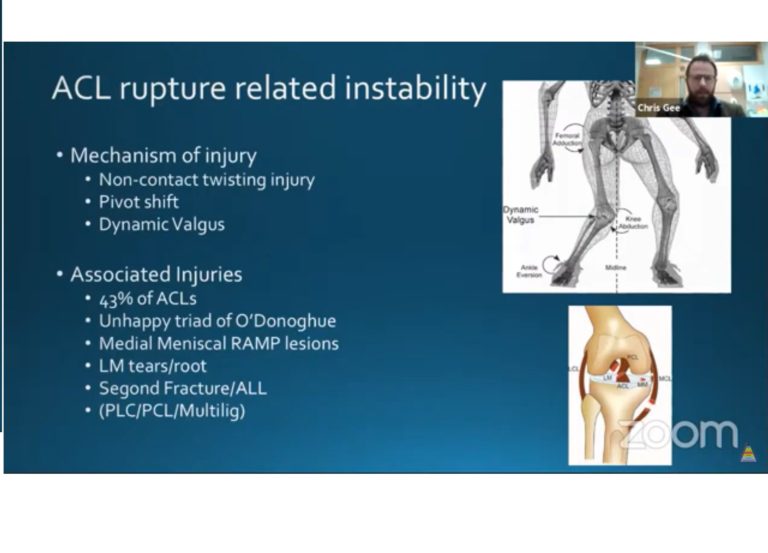 Anterior Cruciate Ligament and Rotational Stability ...