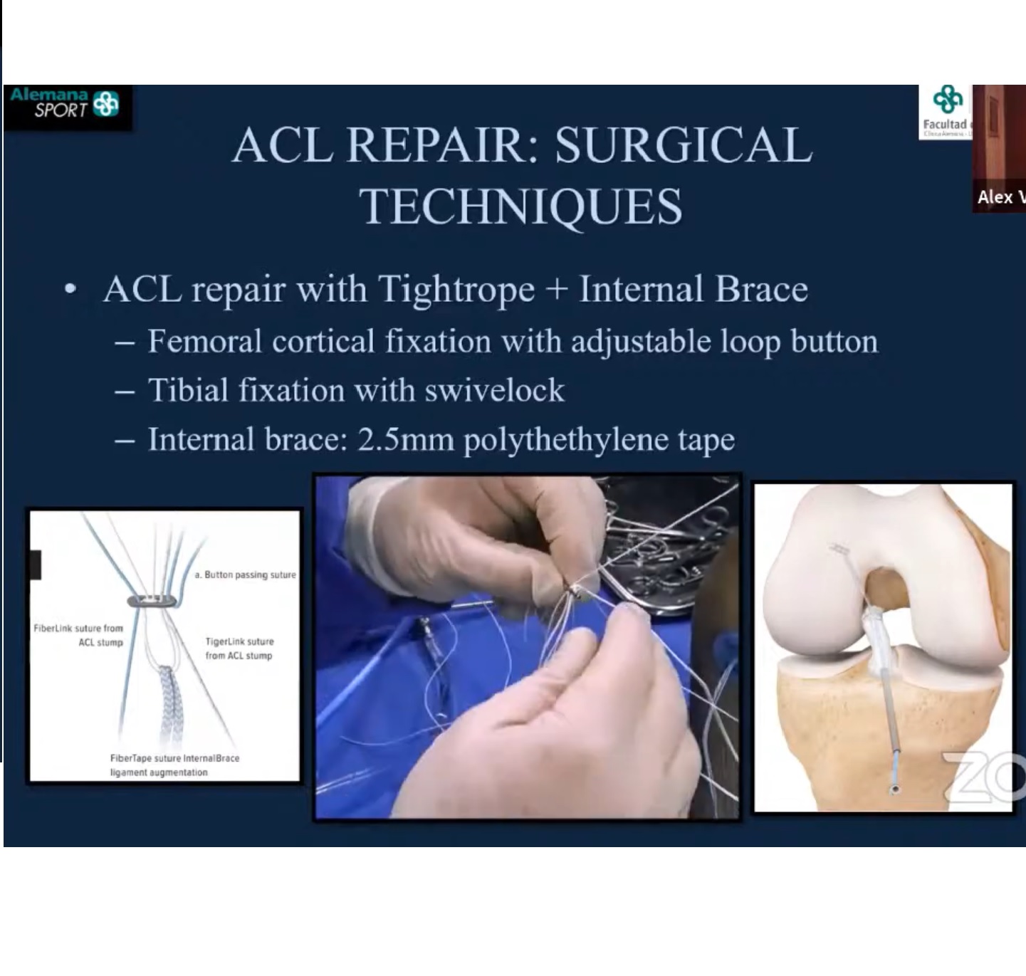 How Long Does An Acl Repair Last