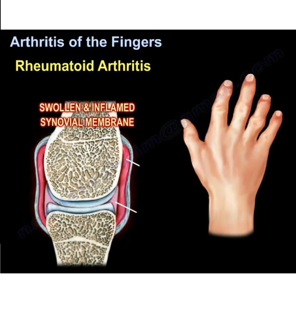 Arthritis of the Fingers —