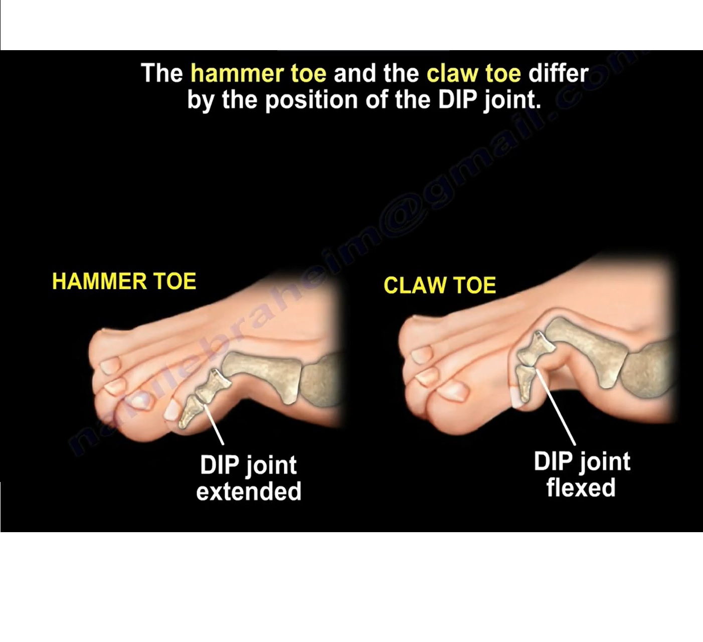 Claw Toes Vs Hammer Toes