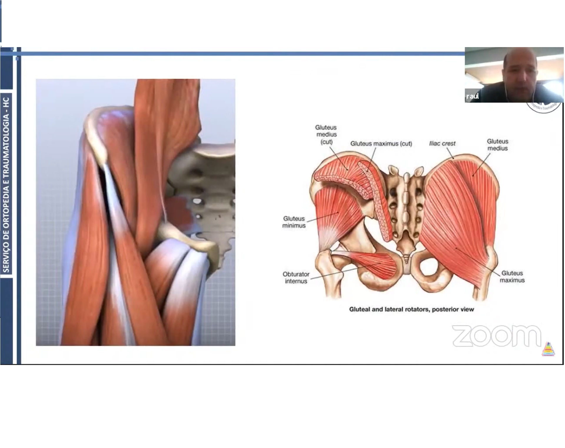 gluteus-medius-tendon-tears-orthopaedicprinciples