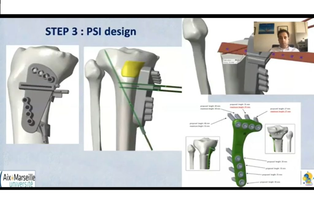 Current Concepts in Knee Osteotomies — OrthopaedicPrinciples.com