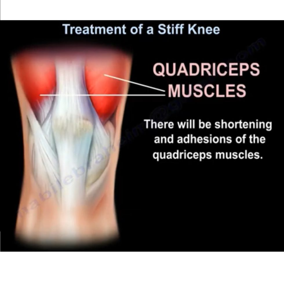 Treatment Of A Stiff Knee OrthopaedicPrinciples