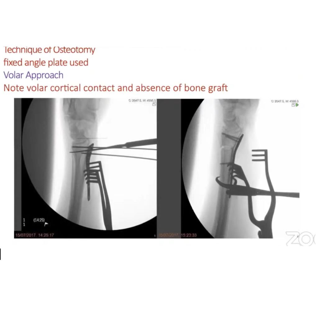 Distal Radius Fracture Malunion And Corrective Osteotomy