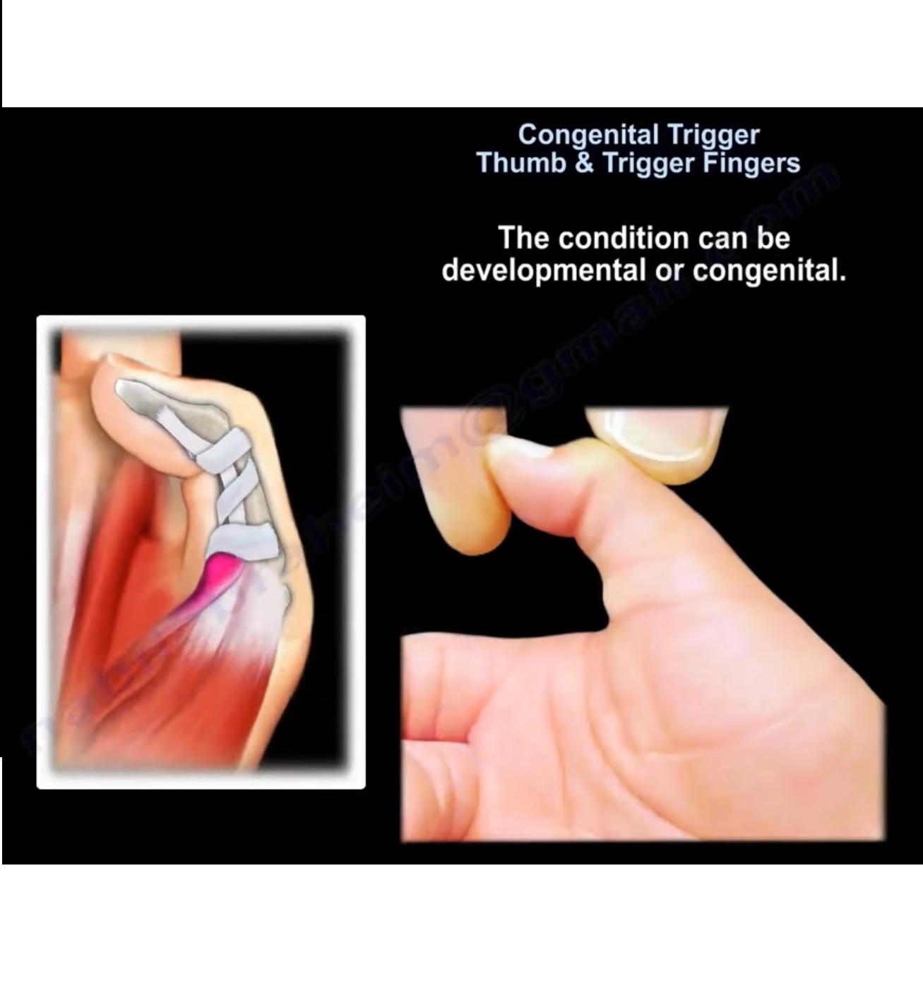 congenital-trigger-thumb-orthopaedicprinciples