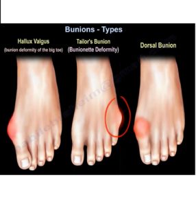 Types of Bunion — OrthopaedicPrinciples.com