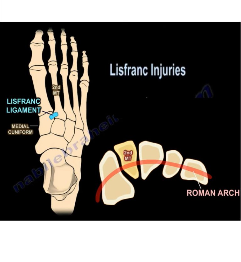 lisfranc injury treatment
