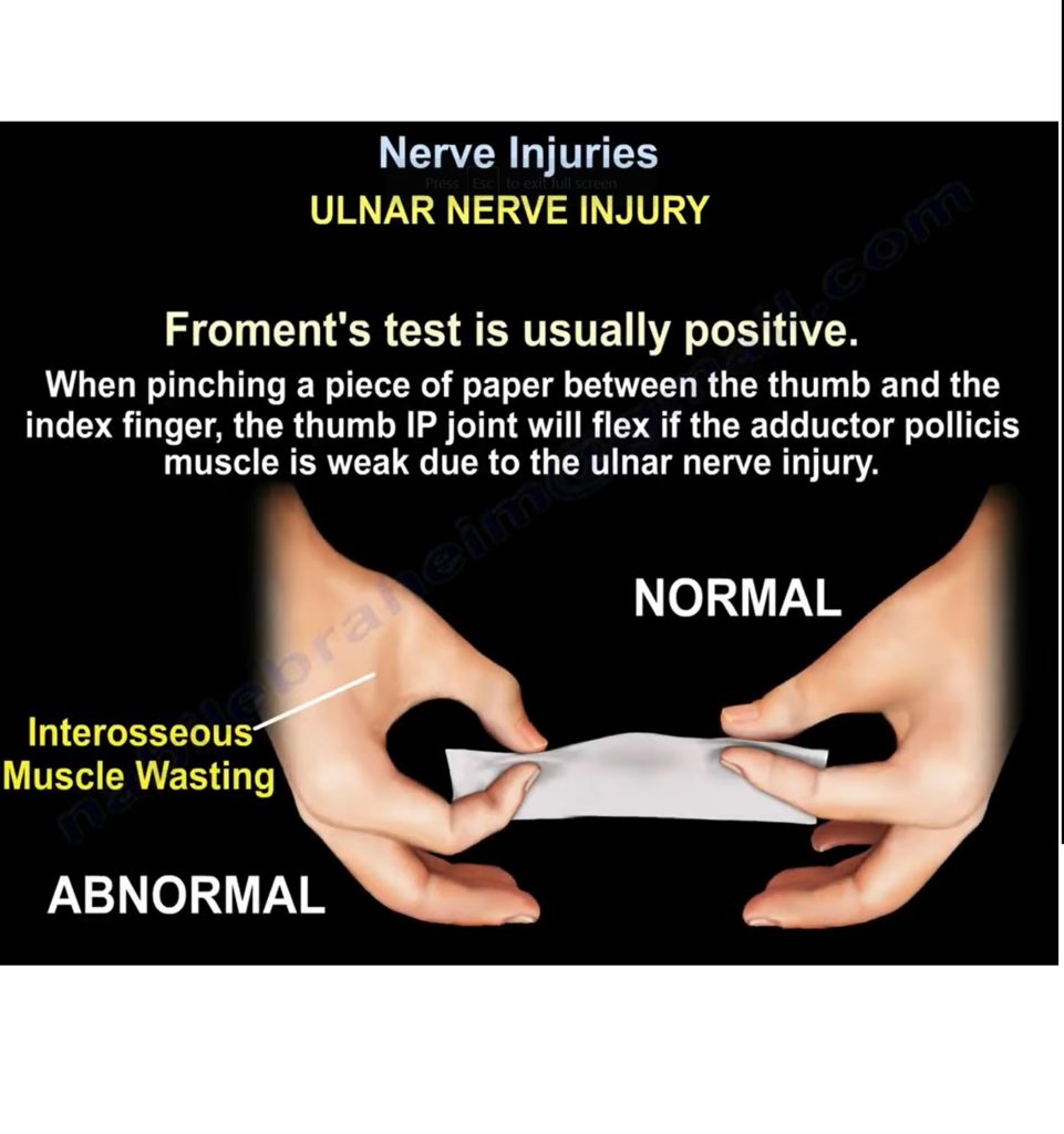 overview-of-nerve-injuries-orthopaedicprinciples