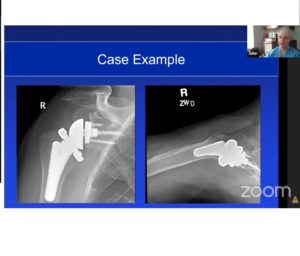Reverse Shoulder Arthroplasty: From Primary to Revision ...