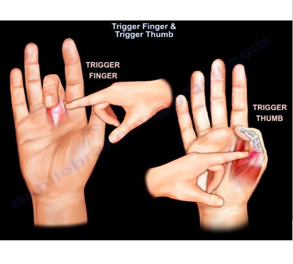 Trigger Finger Diagram