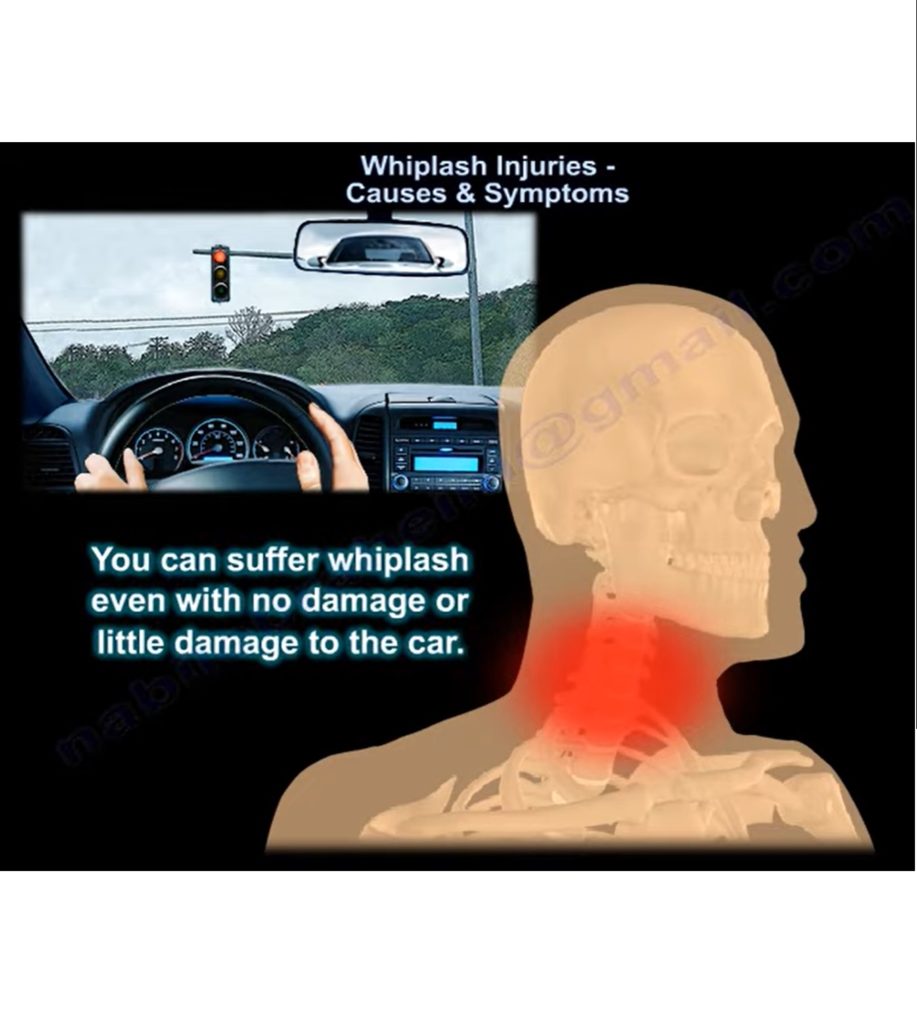 Whiplash Injuries: Causes & Symptoms — OrthopaedicPrinciples.com