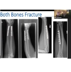 Fractures of the Forearm — OrthopaedicPrinciples.com