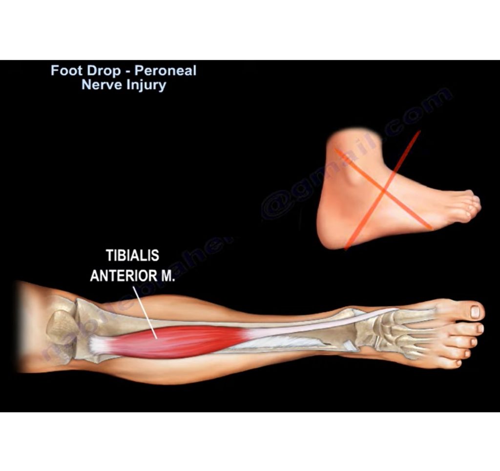 Foot Drop And Peroneal Nerve Injury — OrthopaedicPrinciples.com