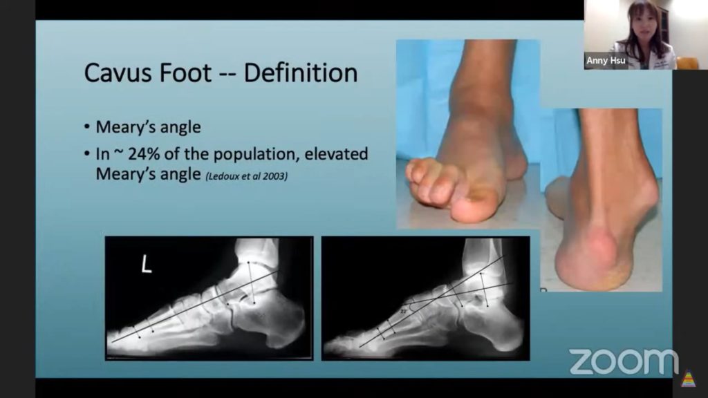 CavoVarus Feet Reconstruction — OrthopaedicPrinciples.com