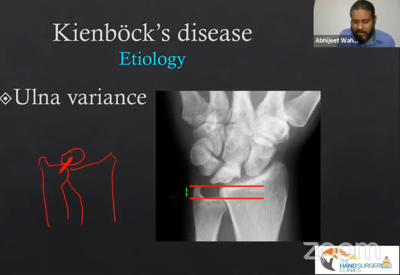 Kienbocks Disease Orthopaedicprinciples Com