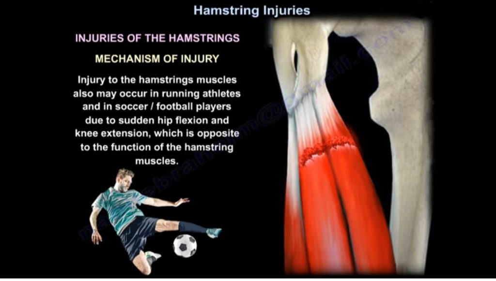 Hamstrings Injuries — OrthopaedicPrinciples.com