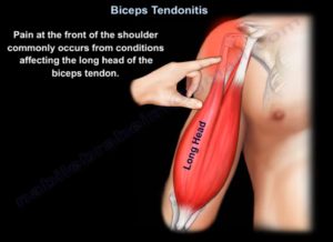 Biceps Tendonitis OrthopaedicPrinciples Com   Biceps Tendon Disorders 300x218 