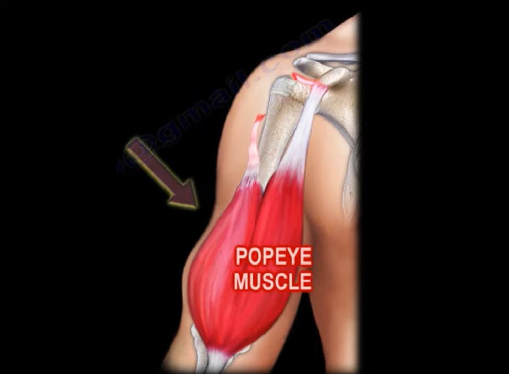 Proximal Biceps Tendon Rupture — 6160