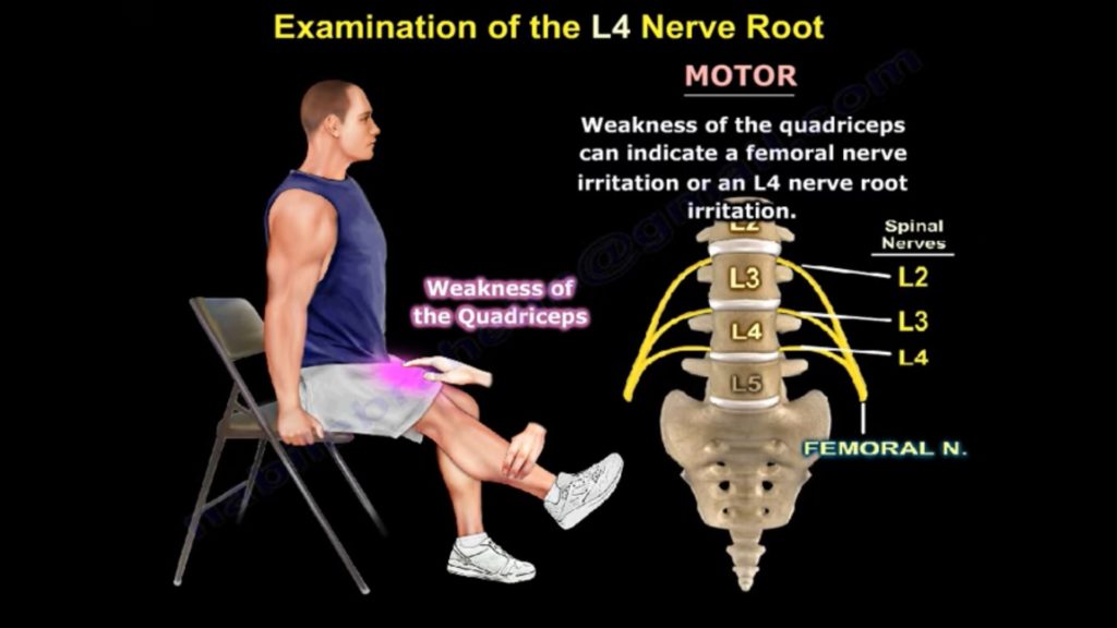 Lumbar Nerve Root Impingement Symptoms