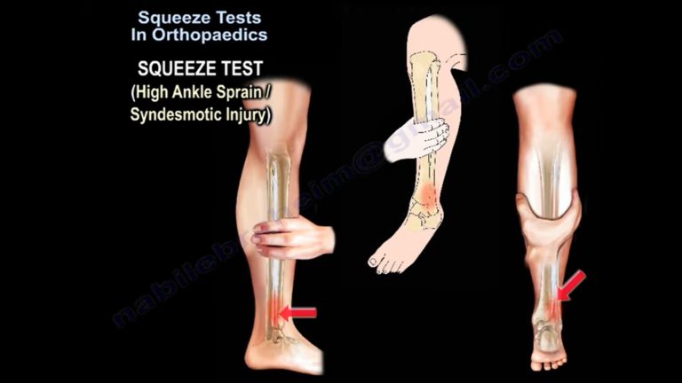 Squeeze Test In Orthopaedics —