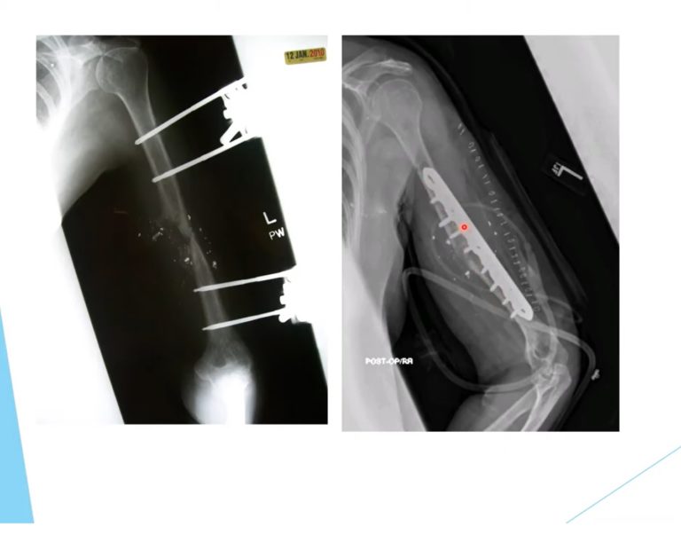 Review Of Upper Extremity Orthopedic Trauma Part 2 ...