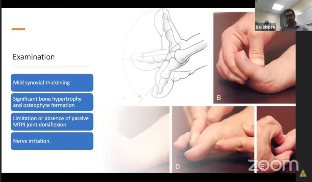 Hallux Rigidus for the FRCSOrth — OrthopaedicPrinciples.com