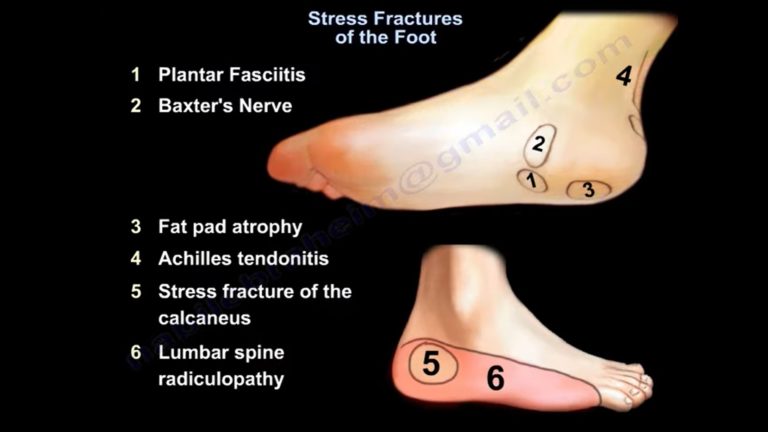 Stress Fractures of the Foot — OrthopaedicPrinciples.com
