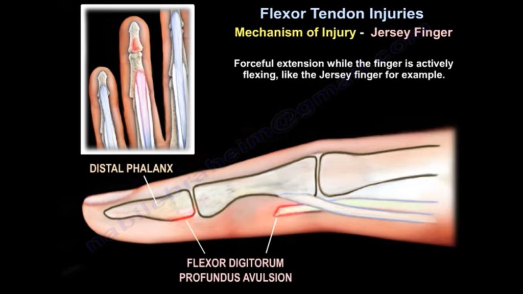 Flexor Tendon Injuries — 2309