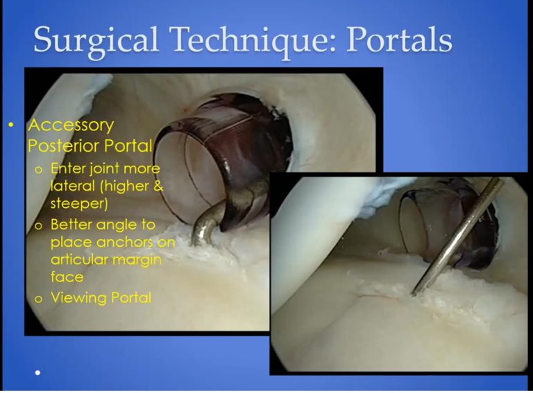 10 Tips for Successful Arthroscopic Bankart — OrthopaedicPrinciples.com