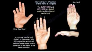 Nerve Injury: Position of the Hand and Fingers — OrthopaedicPrinciples.com