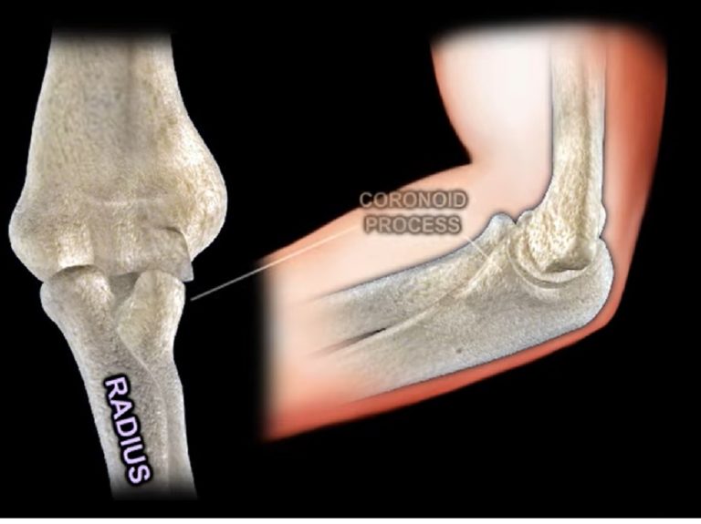 Anatomy of the Elbow — OrthopaedicPrinciples.com