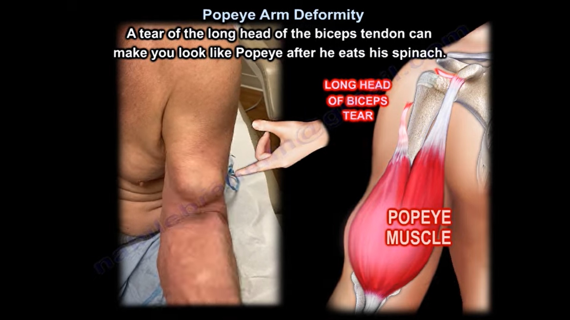 what causes popeye muscle