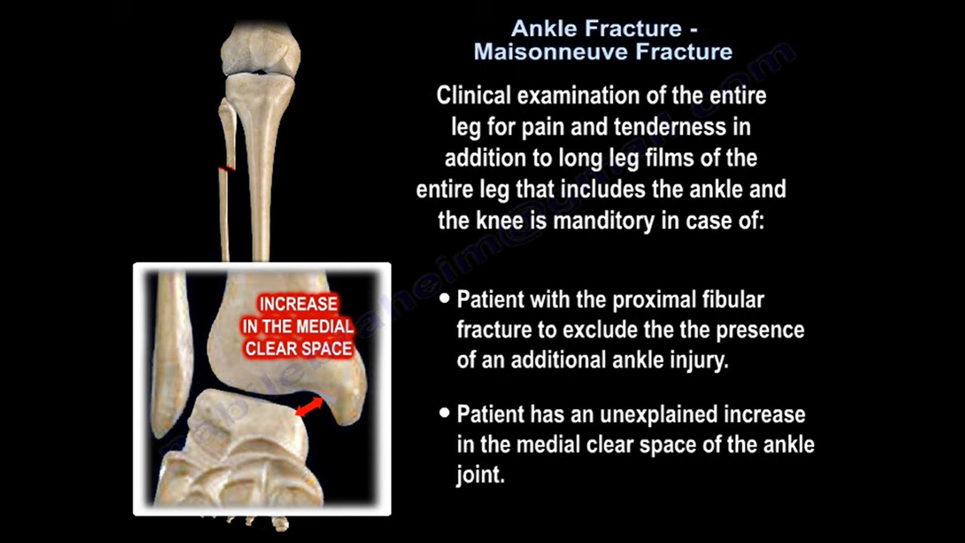 Maisonneuve Fracture Of Ankle OrthopaedicPrinciples