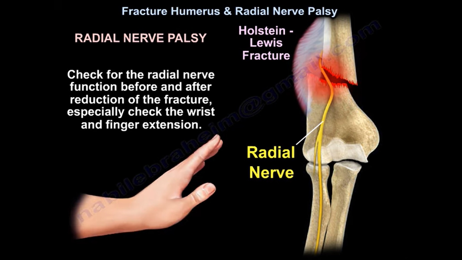 High Radial Nerve Palsy Symptoms Infoupdate