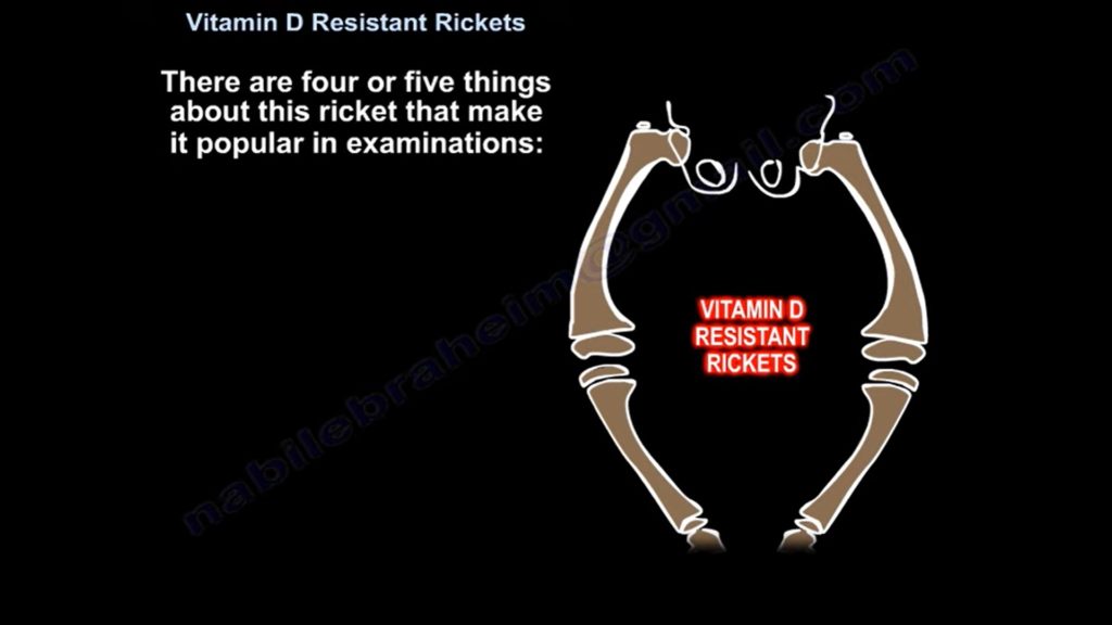 Vitamin D Resistant Rickets OrthopaedicPrinciples vitamin-d-resistant-rickets-orthopaedicprinciples