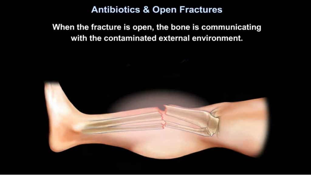 Antibiotics And Open Fractures OrthopaedicPrinciples Com   Antibiotics 1024x580 