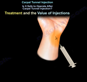 Carpal Tunnel Injection for Carpal Tunnel Syndrome ...