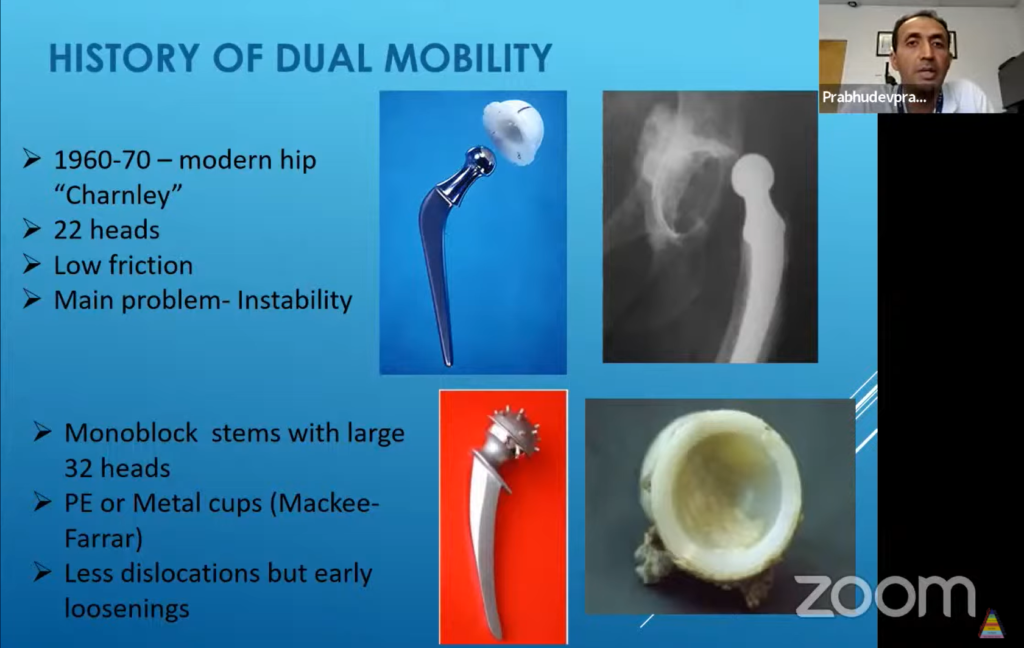 Dual Mobility Components In Total Hip Arthroplasty — 5178