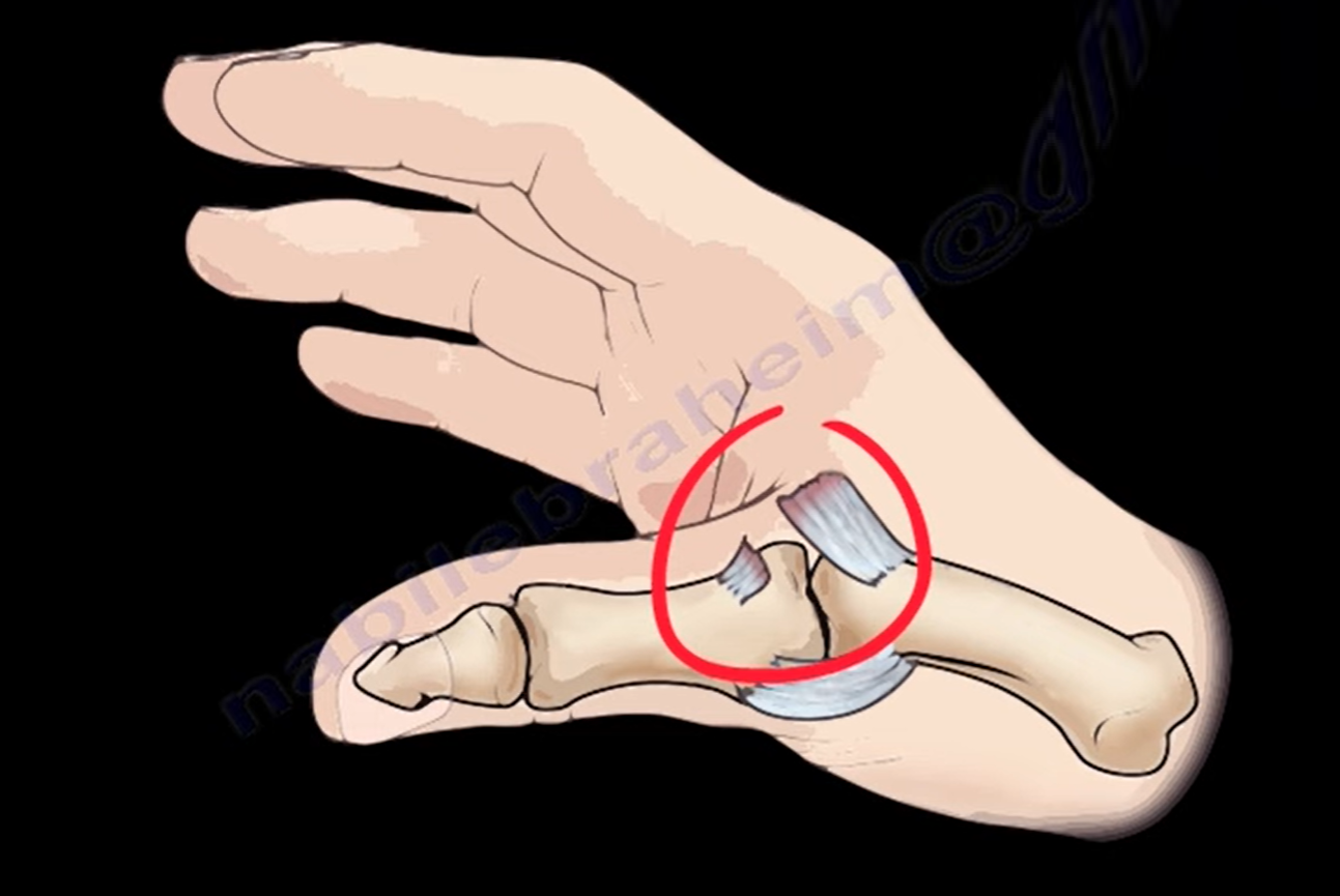 ulnar-collateral-ligament-injury-of-thumb-orthopaedicprinciples