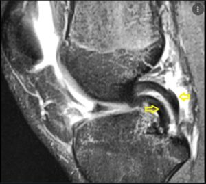 MCQ Sports Knee — OrthopaedicPrinciples.com